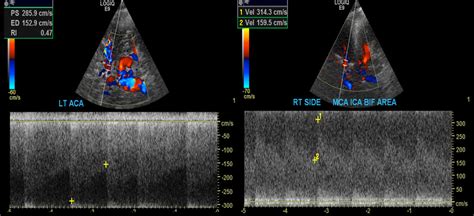 Transcranial Doppler Vascular Ultrasound Intracranial Pressure