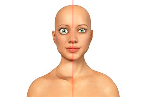 The Link Between Hyperthyroidism And Protruding Or Buggy Eyes