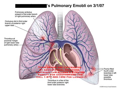 AMICUS Illustration Of Amicus Injury Pulmonary Emboli Embolus Clot