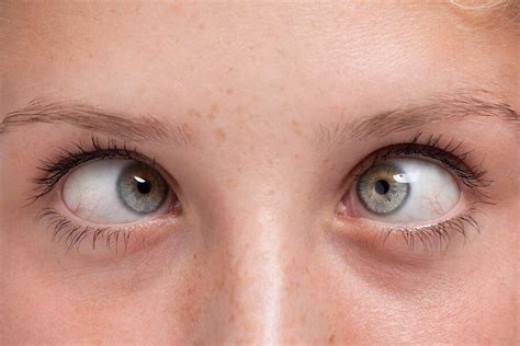 Cross Eye Or Strabismus Treatment Best Eye Hospital In India