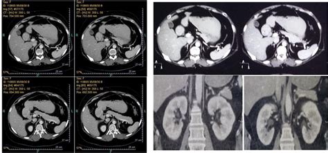 Figure 1 Left Normal Right And Left Adrenal Mri Right Normal Right