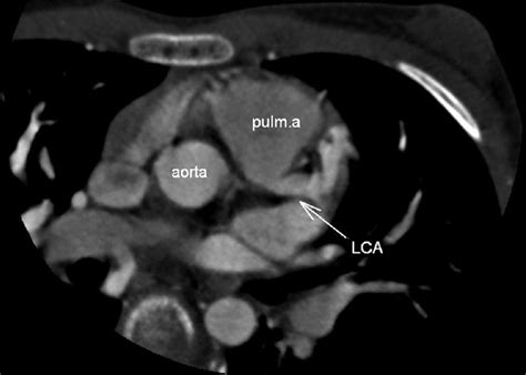Print matrix in diagonal pattern. Anomalous Origin of the Left Coronary Artery from the Pulmonary Artery: Diagnosis with CT ...