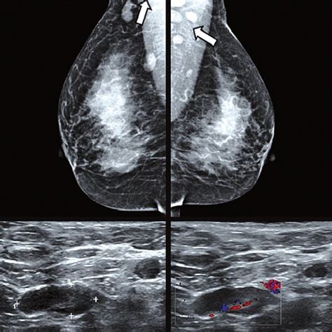 Multiple Bilateral Enlarged Dense Lymph Nodes Were Detected On A