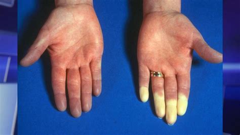 Could It Happen To Me Raynauds Syndrome Youtube