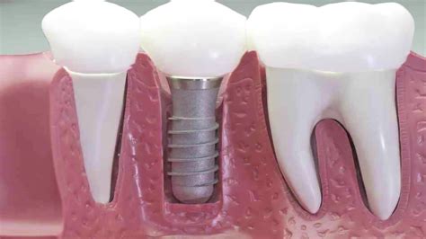 Uno De Cada Cuatro Mayores De 60 Años Usa Implantes Dentales