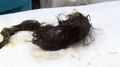 surgeons remove 21 inch hairball from girl s stomach