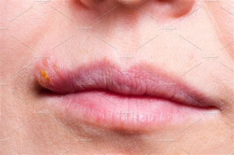 Herpes On The Lip Close Up Macro Containing Problem Illness And Face