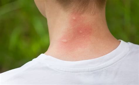 Ever Wonder Why Youre So Prone To Mosquito Bites Ratemds Health News