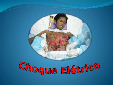 Queimaduras Por Choque Eletrico