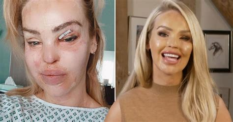 Katie Piper Before And After An Acid Attack Left Her Permanently