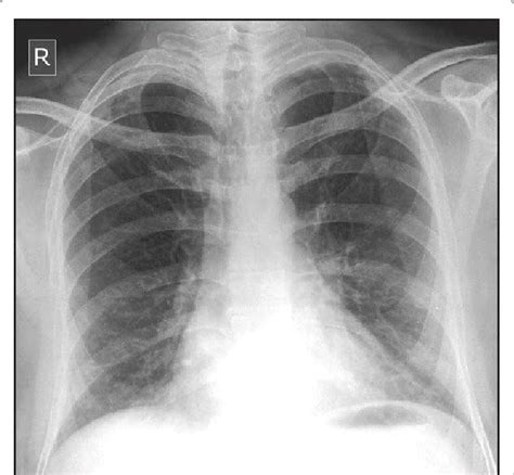 Chest X Ray Showing Diffuse Reticular Nodular Opacities 83