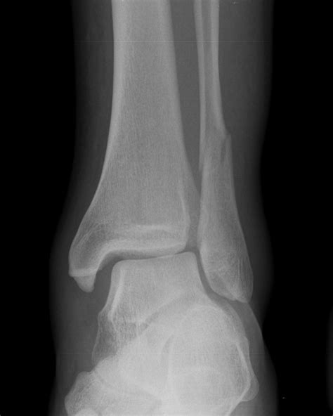 Ankle Distal Fibular Fracture Weber C Image