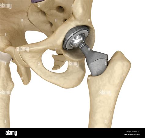 Hip Replacement Implant Installed In The Pelvis Bone Medically Stock