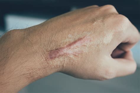 Scar On Human Skin Keloid On Hand Stock Photo Download Image Now Istock