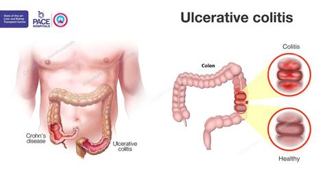 Ulcerative Colitis Causes Symptoms Complications And Treatment