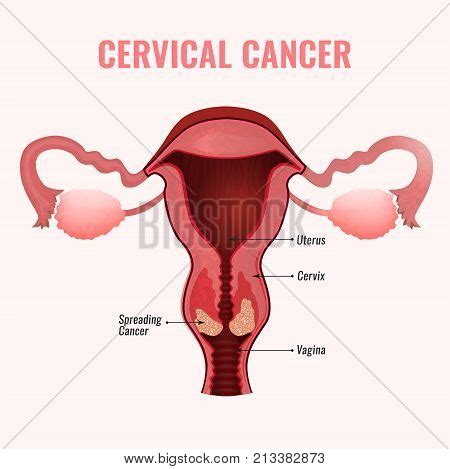 Cervical Cancer Vector Photo Free Trial Bigstock