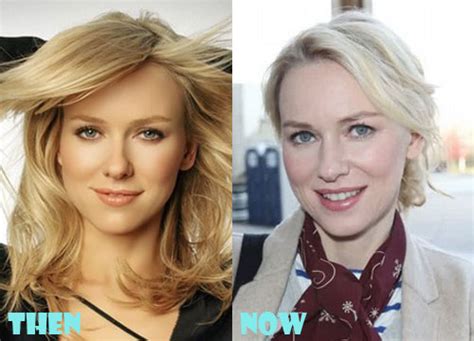 Naomi Watts Plastic Surgery Before And After Picture Lovely Surgery