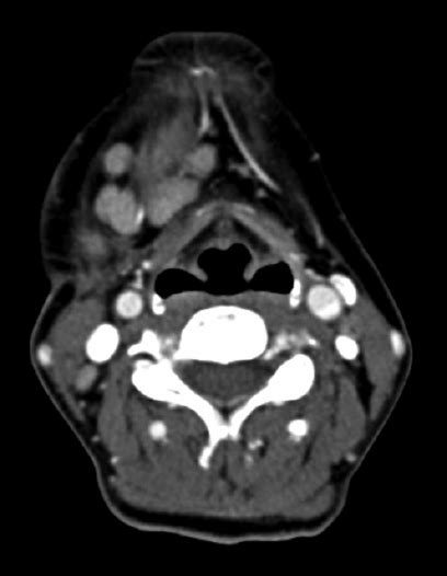Axial Ct Neck Post Contrast Showing Enlarged Right Submandibular