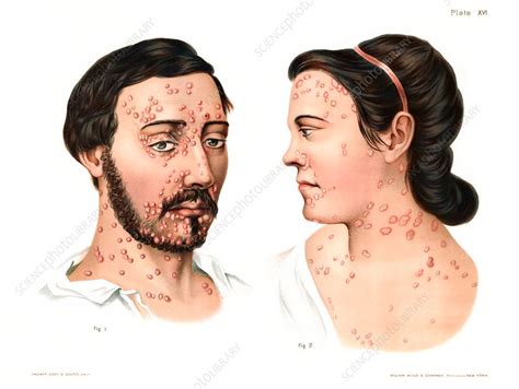 Secondary Syphilis Rash Illustration Stock Image C0308439 Science Photo Library