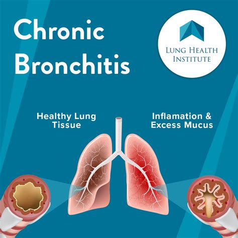 Chronic Bronchitis Is A Progressive Lung Disease That Affects The