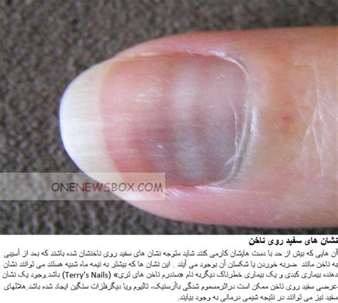 What Your Fingernails Reveal Miracles Of Health