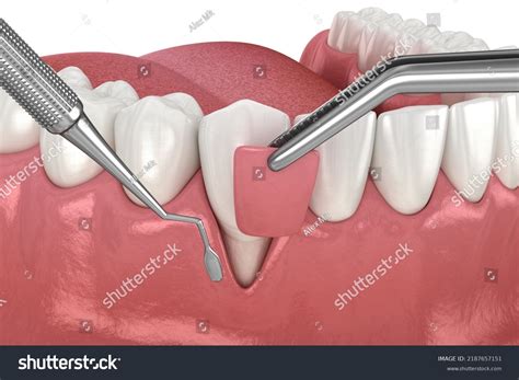 6509 Gingiva Images Stock Photos And Vectors Shutterstock