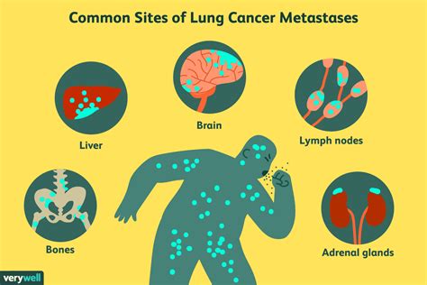 Dónde se disemina el cáncer de pulmón Medicina Básica
