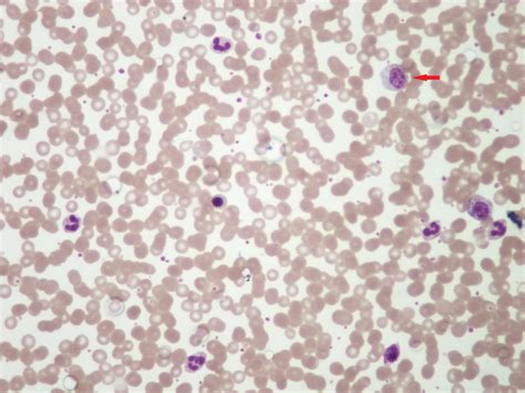 Peripheral Smear Showing Neutrophilic Leukocytosis With Few Myelocytes