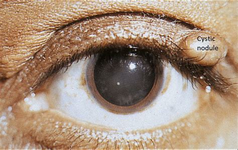 Moran Core Eyelids