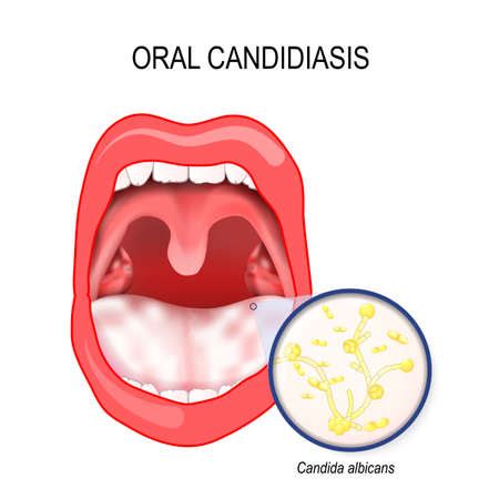 Vector Of Oral Candidiasis Oral Thrush ID 94005951 Royalty Free