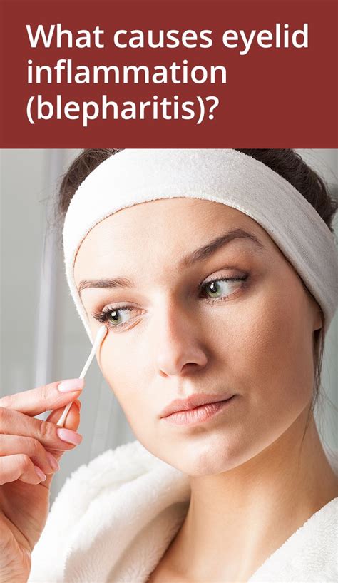 How To Get Rid Of Sore Red Eyelids Blepharitis Blepharitis Rosacea Skin Care Swollen