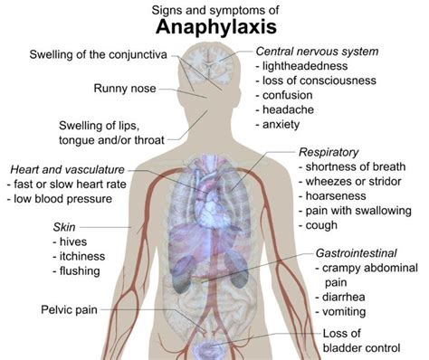 713px Signs And Symptoms Of Anaphylaxis Overview Of Anaphylactic Shock