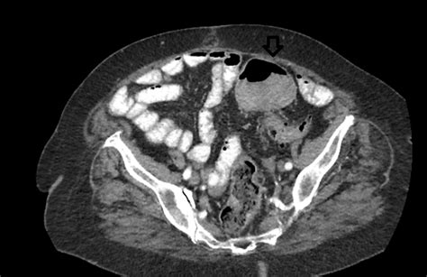 Cureus A Rare Case Of Synchronous Primary Gallbladder And Sigmoid