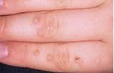 Viral Warts Home Remedies Images