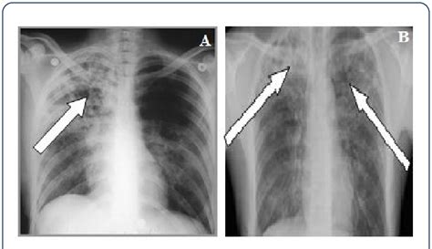 A Posteroanterior Chest X Ray With Heterogeneous Opacity With
