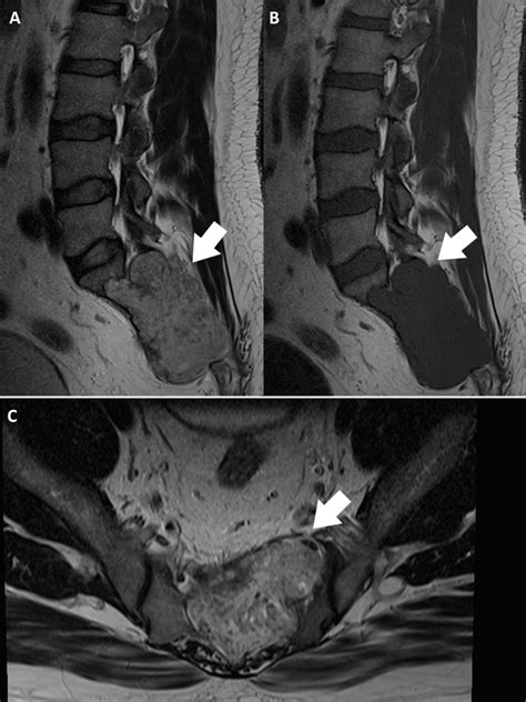 Sacral Chordoma Presenting As Back Pain In The Chiropractic Clinic A