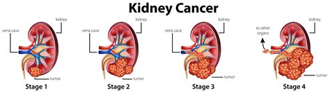 Renal Failure Stages Overview Of Chronic Kidney Disease Stages A