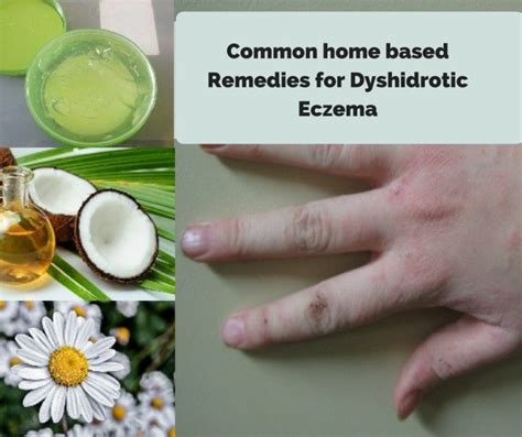 How To Treat Dyshidrosis Dyshidrotic Eczema Cream My Xxx Hot Girl
