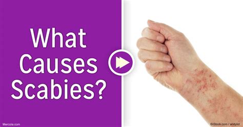 Scabies Rash Pictures Symptoms Treatment Causes 2018 Updated Images