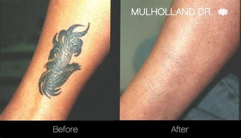 Discover Picosure Tattoo Removal Before And After Latest In Eteachers