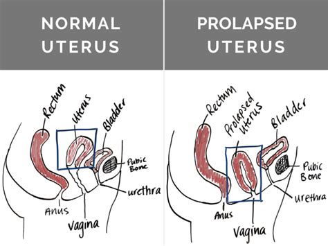 Is Surgery My Best Option For Prolapse Revitalize Physical Therapy Prolapsed Uterus