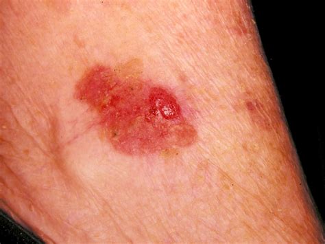 Squamous Cell Carcinoma On Leg