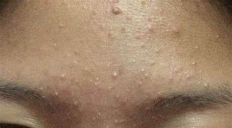 Causes And How To Get Rid Of Whiteheads On Forehead Skincarederm