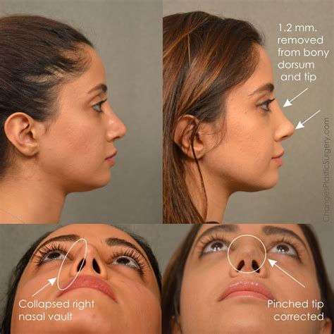 Pin On Nose Lifting And Face Reshaping Hot Sex Picture