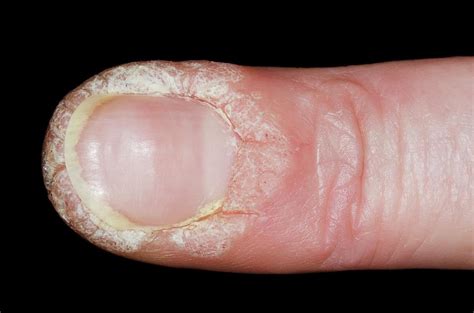 Warts Around A Fingernail Photograph By Dr P Marazziscience Photo Library