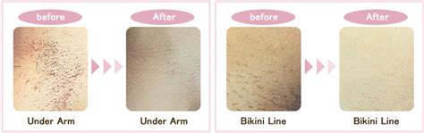 Bikini Line Cyst Treatment