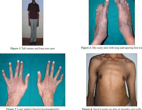 Figure From Marfan Syndrome Report Of Two Cases With Review Of
