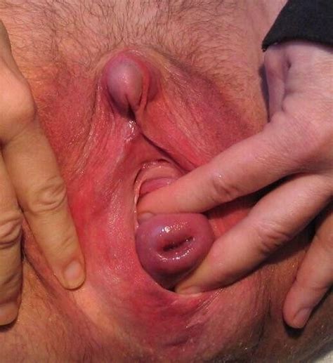 What Is Cervical Cerclage Hot Sex Picture