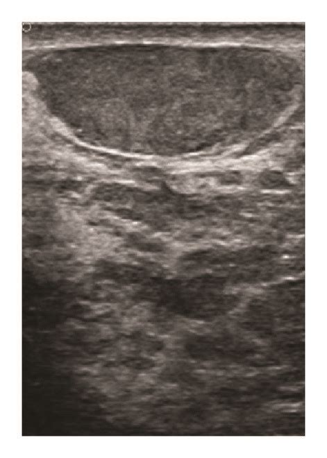Sonographic And Mammographic Findings Ultrasound Of The Left And Right
