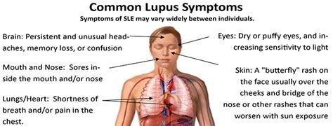 What Is Lupus Health Trend